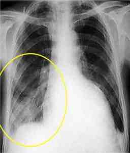 infiltrado-intersticial-radiografia-torax