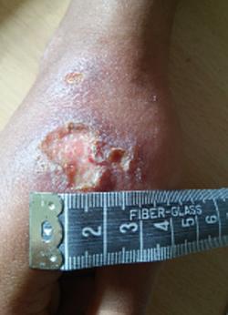 Leishmaniasis cutánea