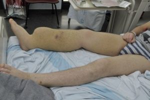 linfedema-sindrome-Milroy