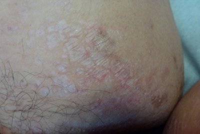 Liquen Esclero Atrofico De Localizacion Poco Frecuente