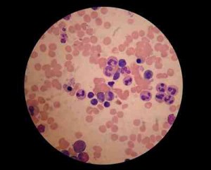 medula-osea-hiperplasia-eritroide