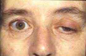 miastenia-gravis-ptosis-palpebral