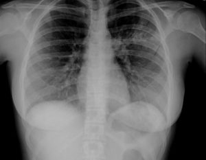 neumonia-Mycoplasma-pneumoniae