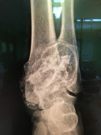 Foto 1. Radiografía anteroposterior donde se aprecia la lesión cartilaginosa compatible con osteocondroma de peroné distal