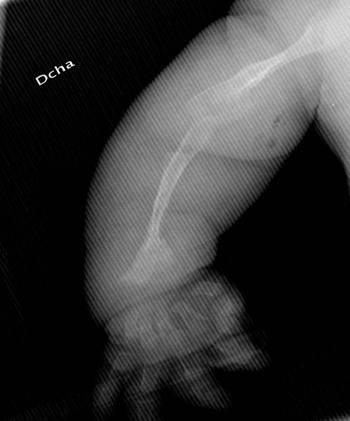 osteogenesis-imperfecta-fracturas