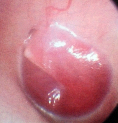 Figura 1: Otoscopia: tumor glómico