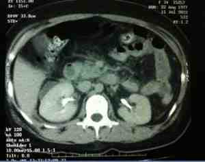 pancreatitis-focal-TAC
