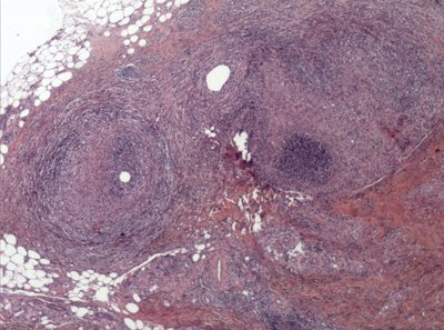 paniculitis-neutrofílica-lobulillar-y-septal