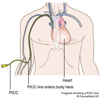 pic-cateter-presion-intracraneal