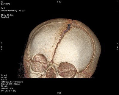 plagiocefalia-tc-3d-craneal-imagenes