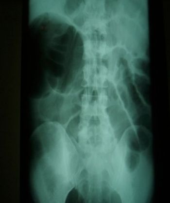 radiografia-abdomen-dilatacion-asas-intestino-delgado