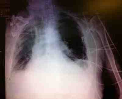 radiografia-torax-EAP