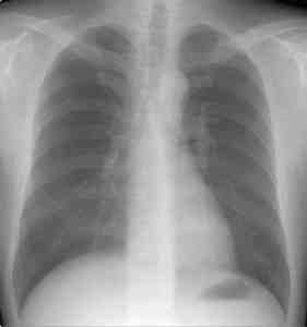 rx-torax-enfermedad-venooclusiva