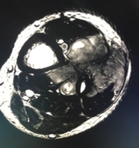 sarcoma-miembro-inferior