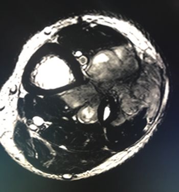 sarcoma-miembro-inferior
