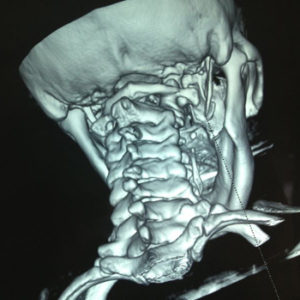 sindrome-de-eagle-apofisis-estiloides