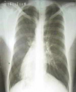 situs-inversus-dextrocardia