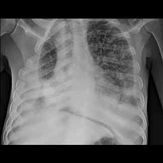 tuberculosis-radiografia-torax