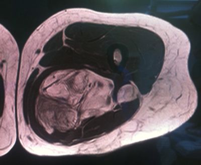 tumor-muslo