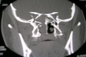 tumoracion-sinusal-tac-coronal