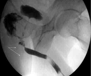 uretrocistografia-retrograda-fistula-rectouretral