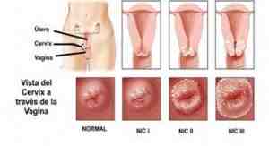 CIN-NIC-cancer-cervix
