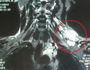 hemangioma-cervical-rm-con-contraste