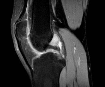 RNM-rodilla-corte-sagital