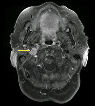 Figura 2: RNM: tumor glómico