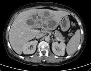 TAC-abdominal-absceso