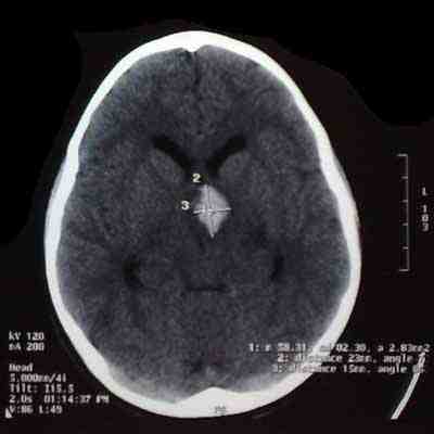 TAC-cerebral-hematoma