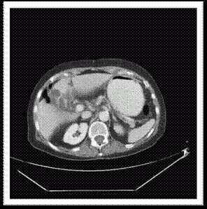 TC-multifasica-fase-arterial