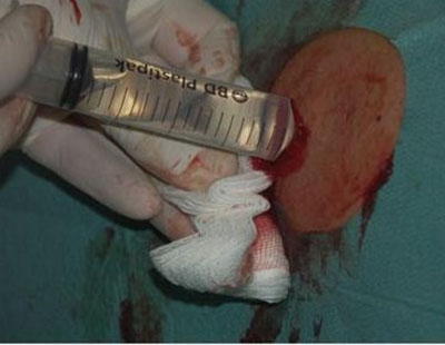 Imagen 2: lavado con suero fisiológico
