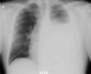 cancer-de-pulmon-no-microcitico-rx-torax-AP