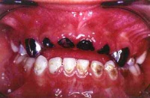 caries-rampante
