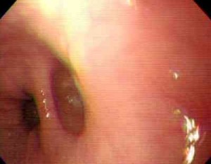 diverticulo-esofagico-de-Grenet