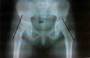 epifisiolisis-femoral-superior