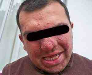 esclerosis-tuberosa-angiofibromas-faciales