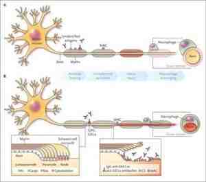 inmunopatogenia-sindrome-Guillain-Barre