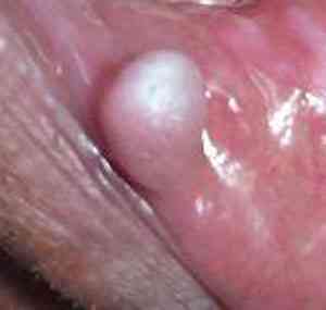 lesion-hiperplasica