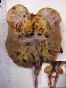 lesion-tumoral-ureter