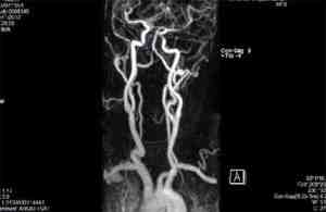 malformacion-arteriovenosa-congenita-cerebral