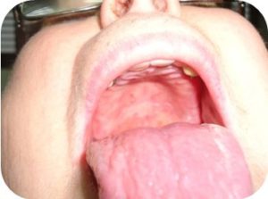 manchas-rojas-blancas-mucosa-palatina
