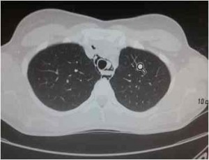 neumomediastino-espontaneo-TAC