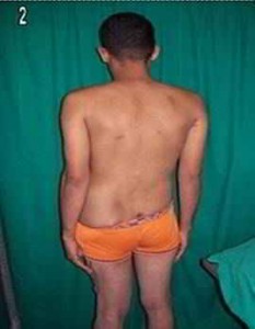 neurofibromatosis-neurofibromas