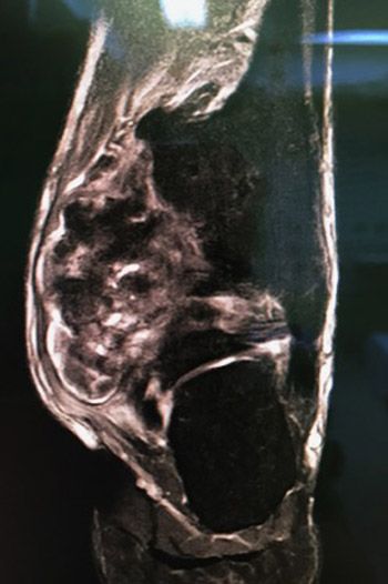Foto 2. Resonancia Magnética, donde se aprecia la lesión cartilaginosa cuyo pedículo está en el peroné y se extiende hacia la zona medial y posterior atrapando al flexor del primer dedo y comprimiendo la zona del tibial posterior.