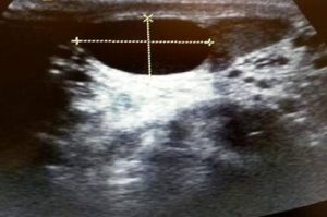quiste-epididimo