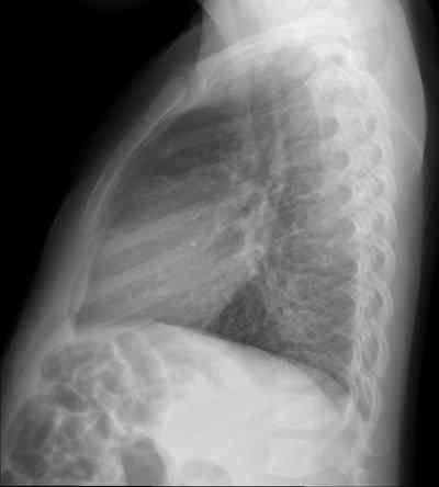 síndrome-de-Poland-radiografia