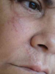 sarcoidosis-papulas