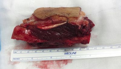sarcoma-tumor-miembro-inferior
